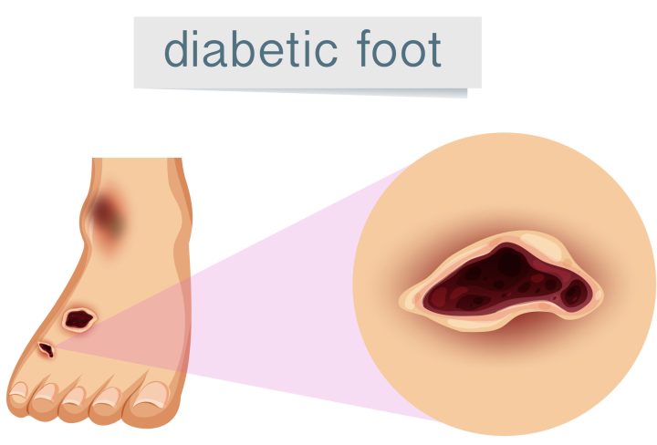 A human foot with diabetic  illustration